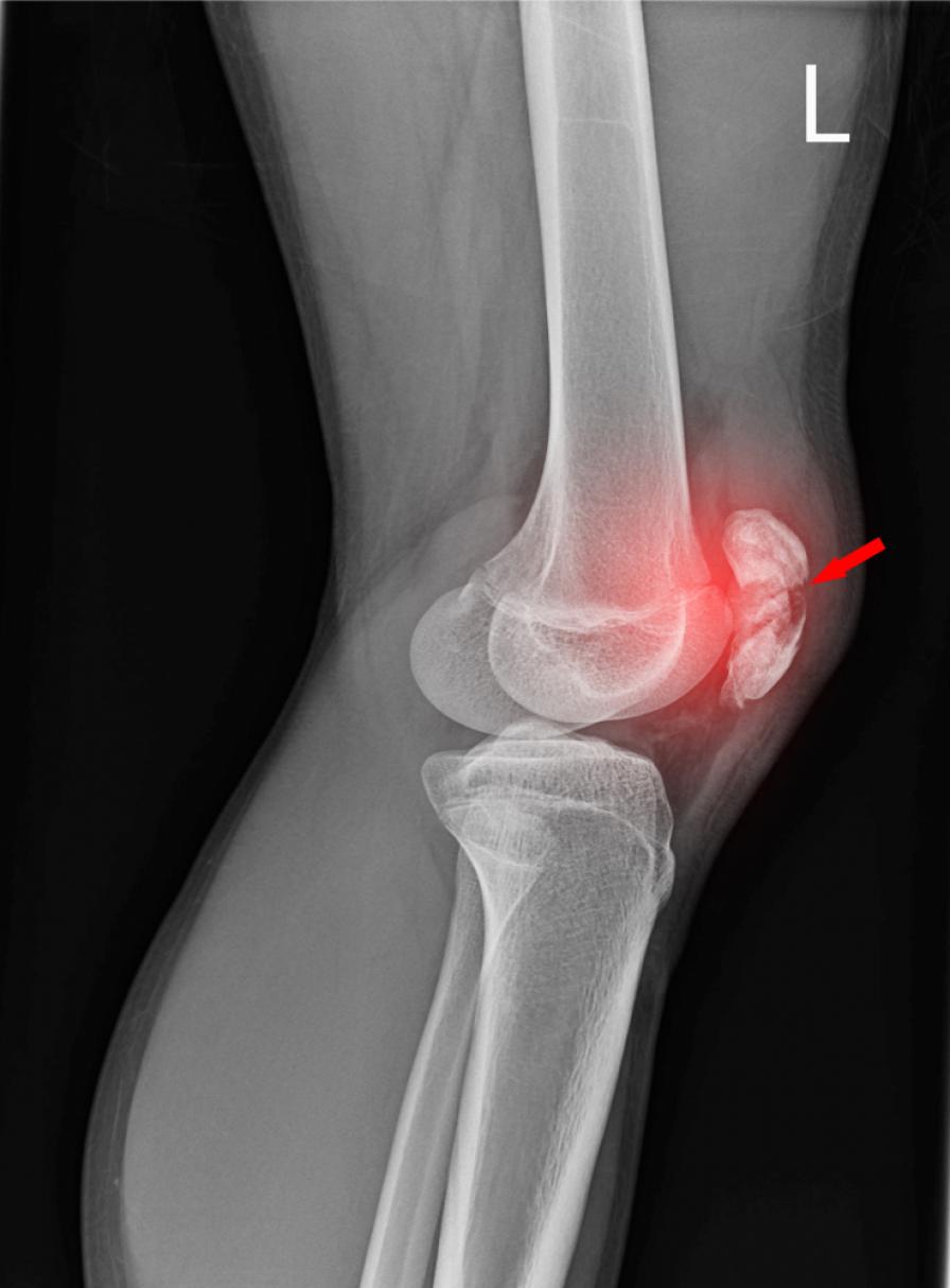 Der Bruch einer Kniescheibe lässt sich auf einem Röntgenbild gut erkennen
