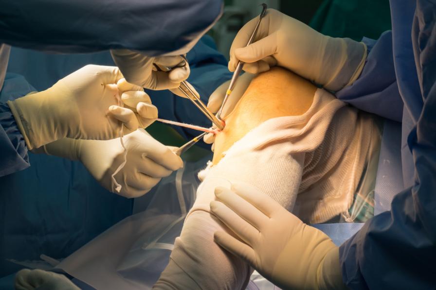 Ein gerissenes Band am Knie muss häufig operativ behandelt werden