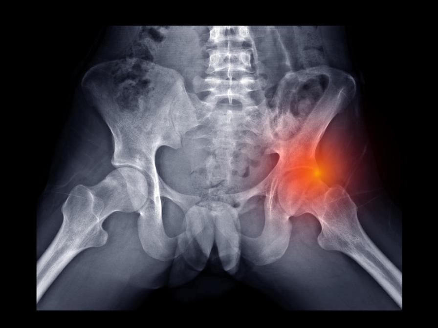 Das Röntgenbild einer Hüftverletzung
