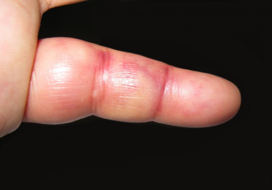 Fingerluxation verursacht unter anderem Schwellungen