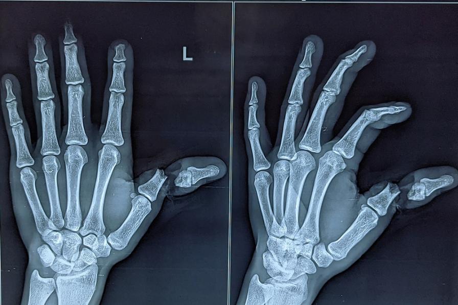 Fingerluxationn auf einem Röntgenbild
