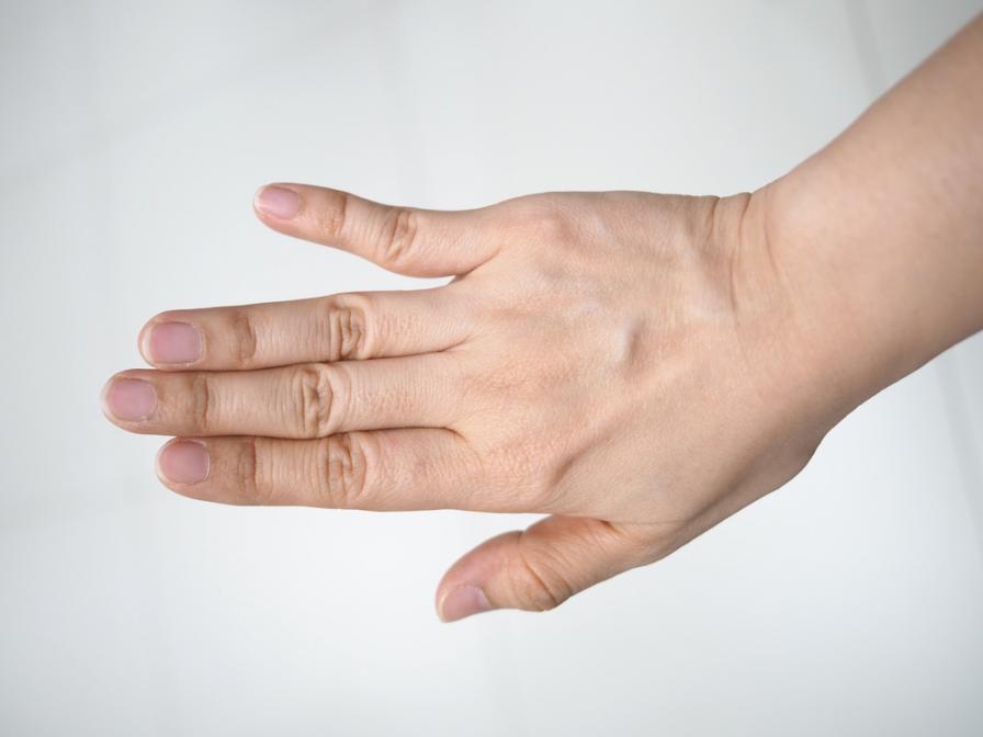 Fingerluxation am kleinen Finger
