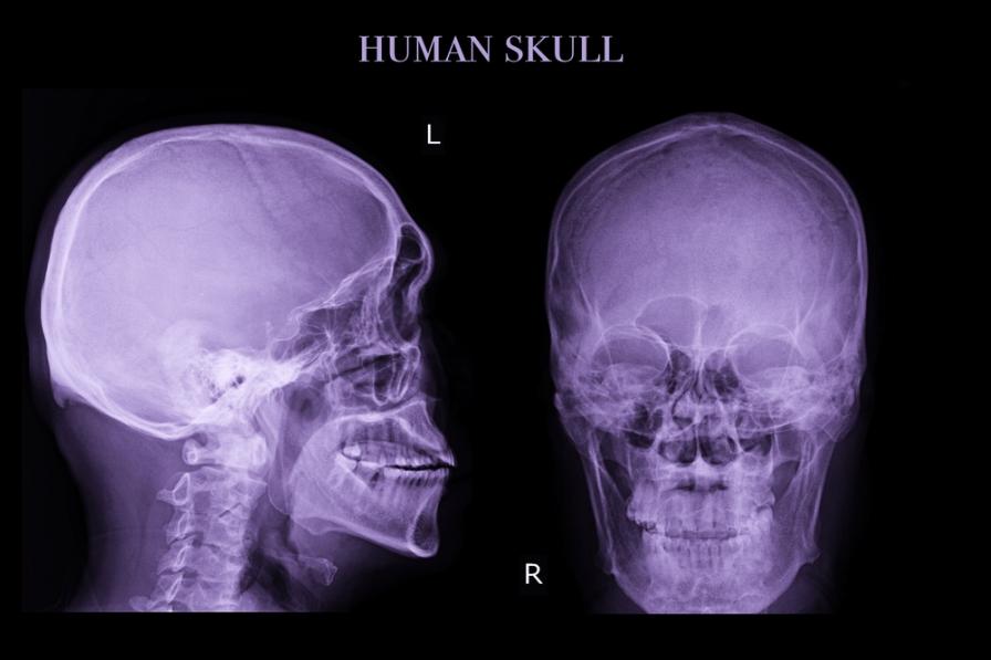 Gesichtsknochen im Röntgenbild