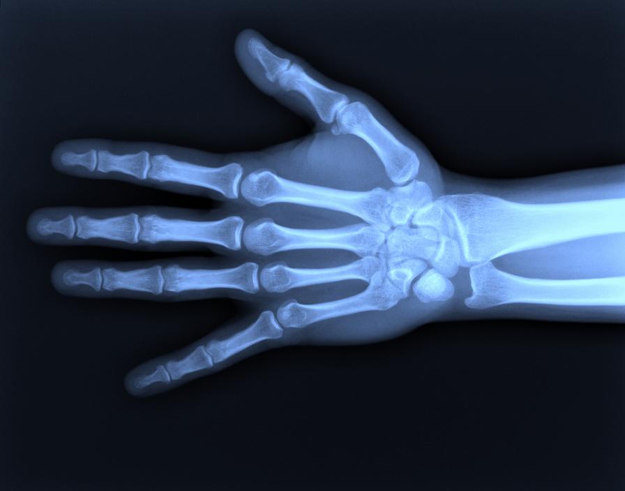Handbrüche lassen sich auf einem Röntgenbild gut erkennen