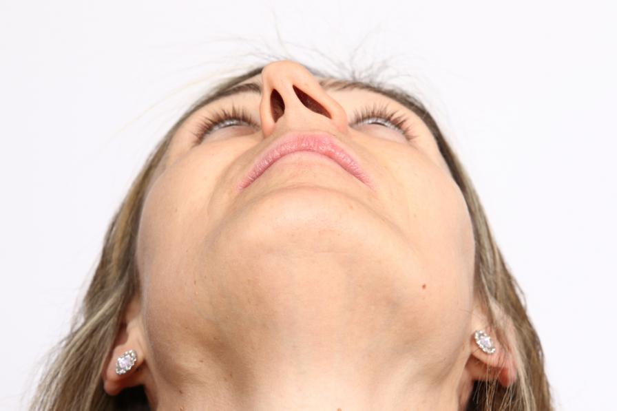 Eine deformierte Nase