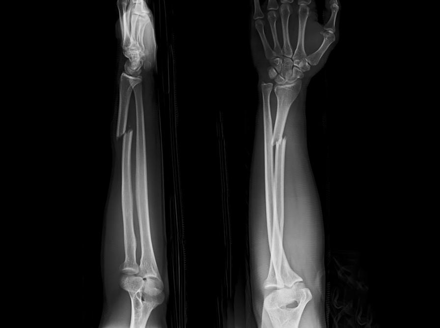 Röntgenbilder einer Fraktur des Unterarms