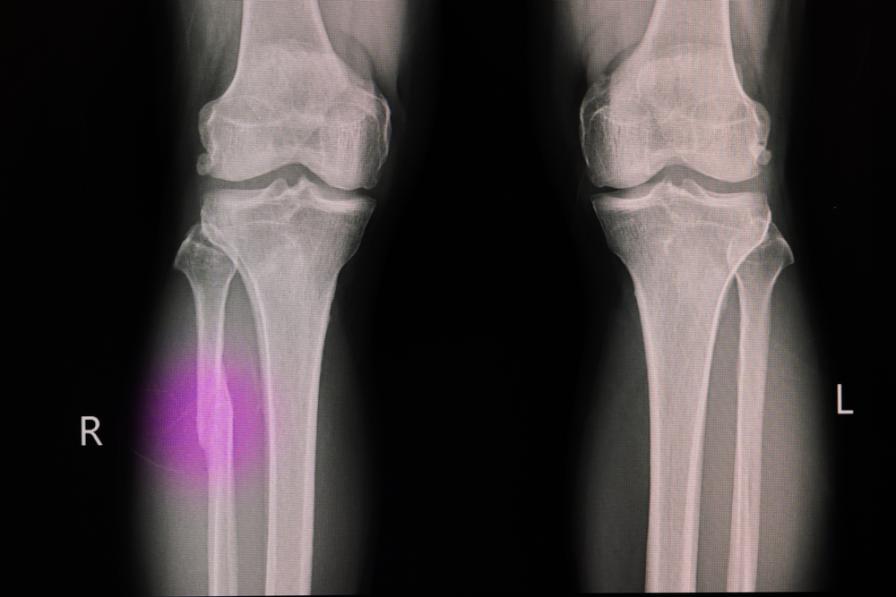 Die Fraktur des Unterschenkels in einem Röntgenbild
