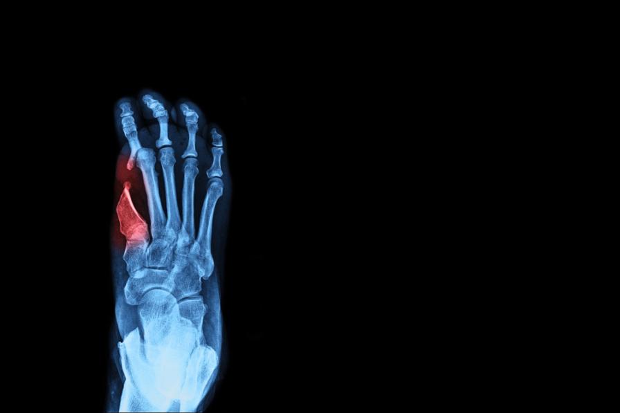 Ein Röntgenbild der Fußknochen