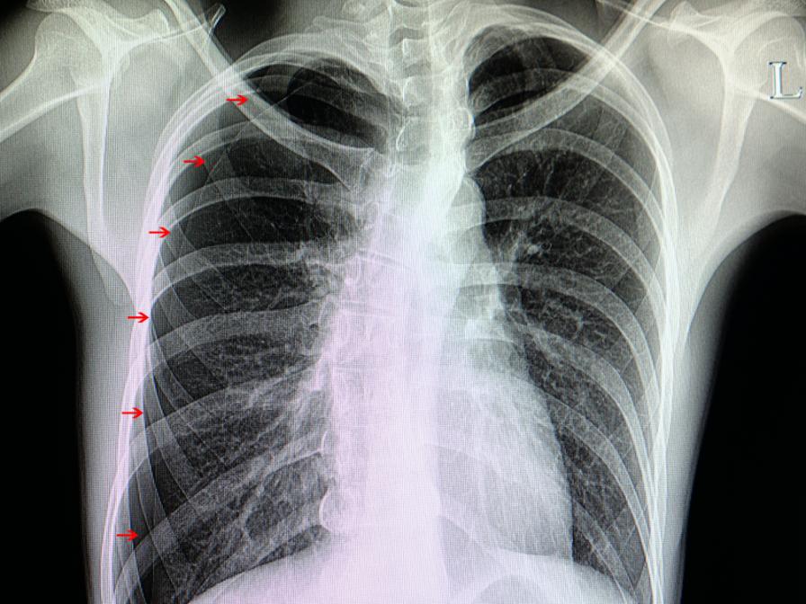 Das Röntgenbild zeigt die Fraktur der Rippen