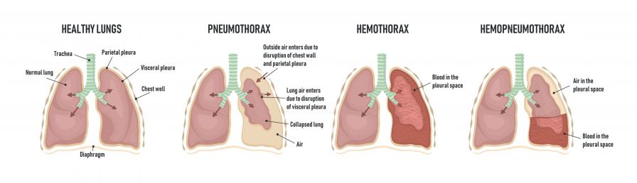 Das passiert bei einem Pneumothorax