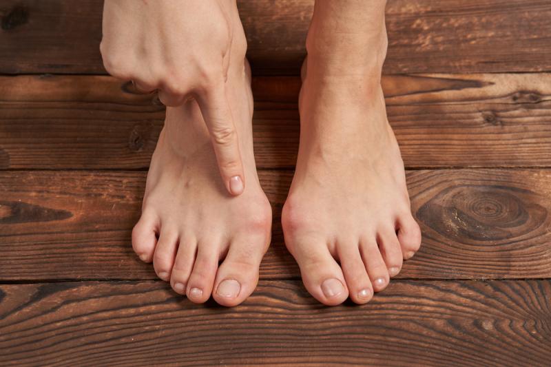 Ein Hallux Valgus entsteht, wenn sich die Statik des Fußes krankhaft verändert.
